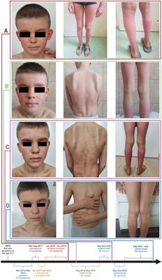 Case report: Successful treatment with biologics in a pediatric patient with a severe inflammatory skin disease and novel CARD14 mutation